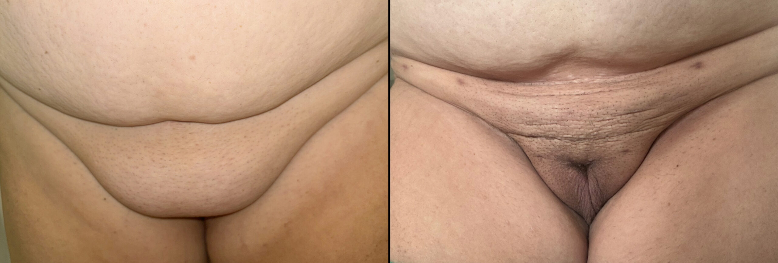 FUPA Pubic fat removal by liposuction